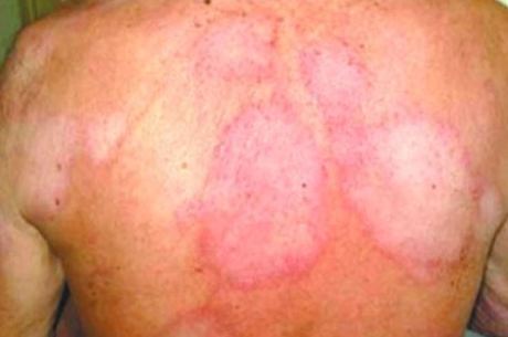 Janeiro Roxo alerta para a conscientização sobre a hanseníase