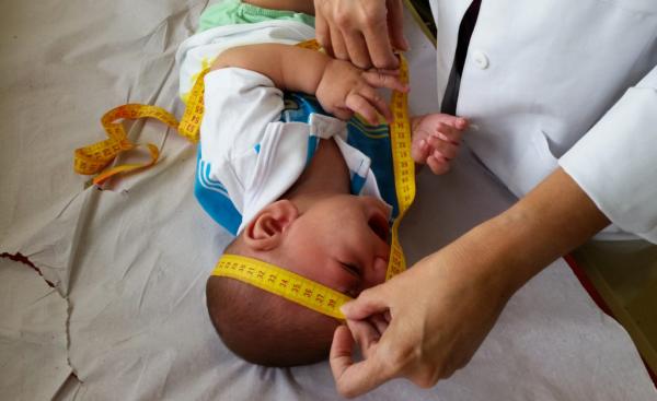 Crianças com síndrome congênita da zika têm mais chances de morrer