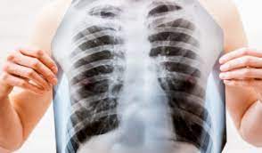 Saúde de Rio Verde inicia campanha contra a tuberculose na segunda-feira, 21 