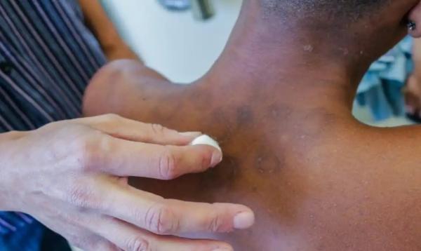 Ministério da Saúde deixa faltar remédios para hanseníase