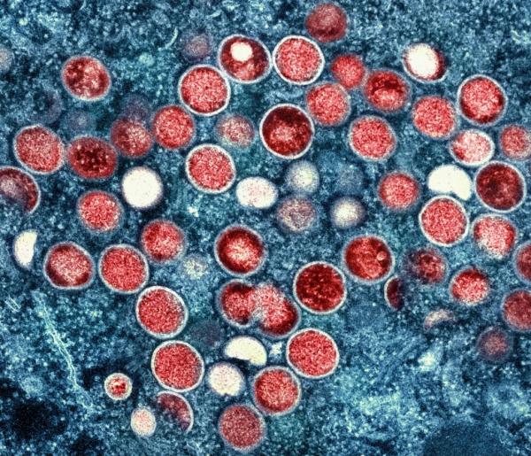 Ministério da Saúde confirma 55 casos de Mpox no Brasil